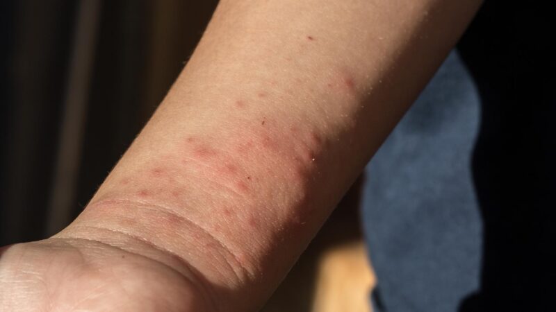 What Does a Sand Flea Bite Look Like